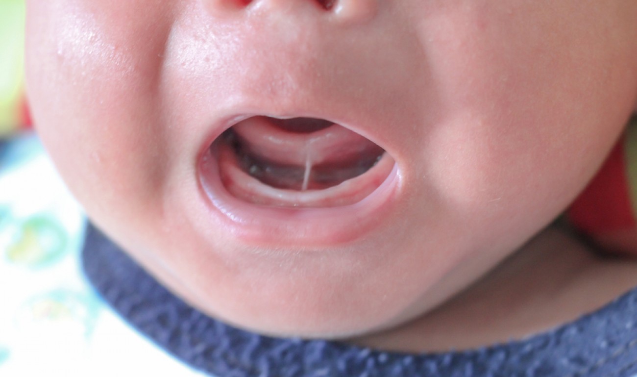 Pediatras pedem o fim da exigência do Teste da Linguinha obrigatório