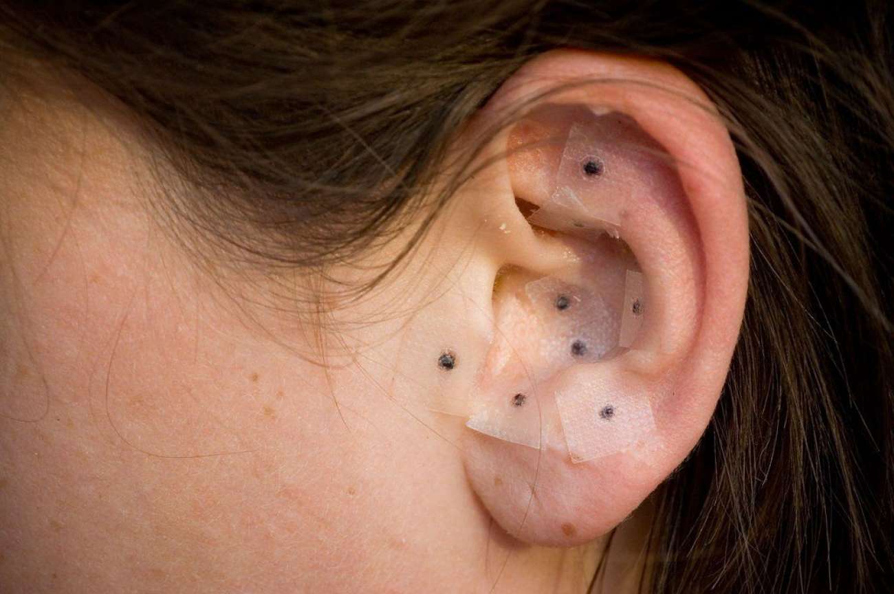 Ibiaçá anuncia Auriculoterapia disponível pelo SUS