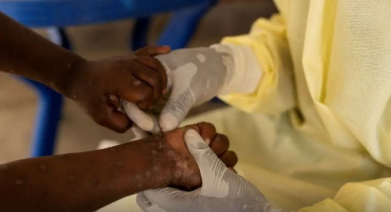 Brasil registra 88 casos de Mpox em 2026