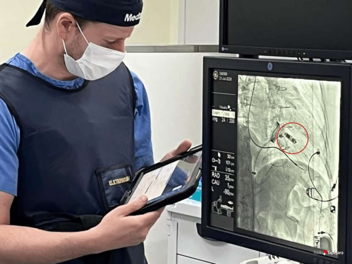 Hospital São Vicente realiza primeiro implante de marcapasso sem eletrodos no interior do RS